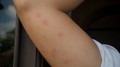 picaduras de chinches